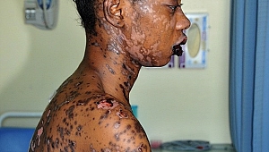 ANTİBİYOTİK KULLANAN ŞARKICI ÖLÜMDEN DÖNDÜ!