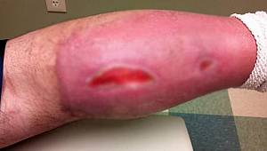 Et yiyen bakteri hayatını kararttı!