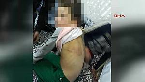 Babasından İşkence Gören Suriyeli Kız, Devlet Korumasına Alındı