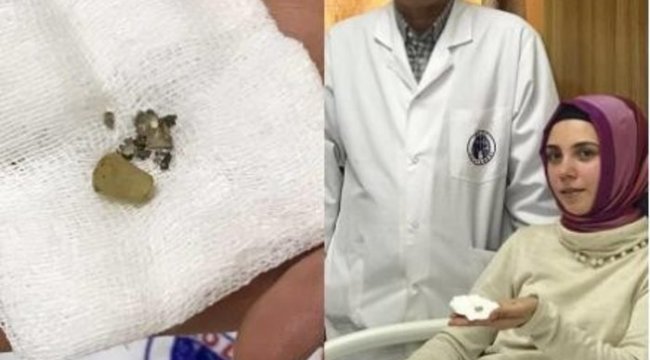 Burnundaki cisimle 24 yıl yaşadı