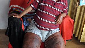 Fil hastalığına yakalanan Sabri Reisoğlu'nun bacaklarını kurtlar yiyor