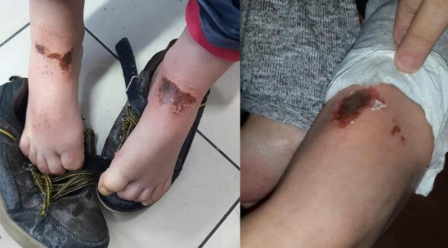 Afyonkarahisar'daki 'gizemli yanıklar'ın nedeni belli oldu