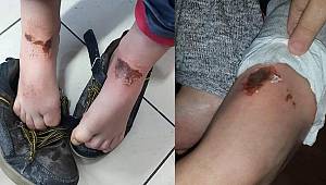 Afyonkarahisar'daki 'gizemli yanıklar'ın nedeni belli oldu