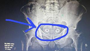 Röntgende ortaya çıktı! Bağırsaklarında gizlemiş...