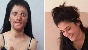 Yüzüne asit döken erkek arkadaşını affeden Berfin özür diledi: Yanlış ve sağlıksız bir karardı