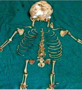 36 Yıl Karnında Taşıdı 