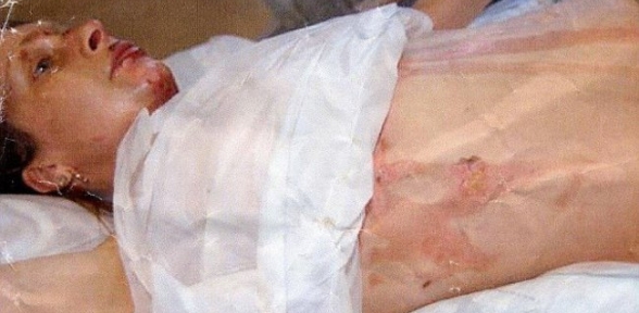 İngiliz kıskanç sevgili kız arkadaşını yaktı
