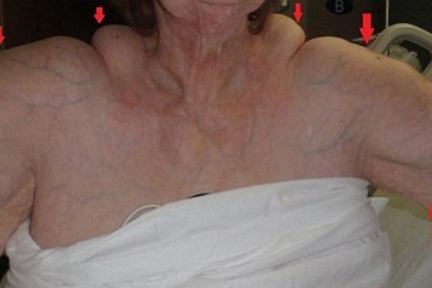 Aşırı Alkol Tüketince Sırtında Hörgüç Çıktı