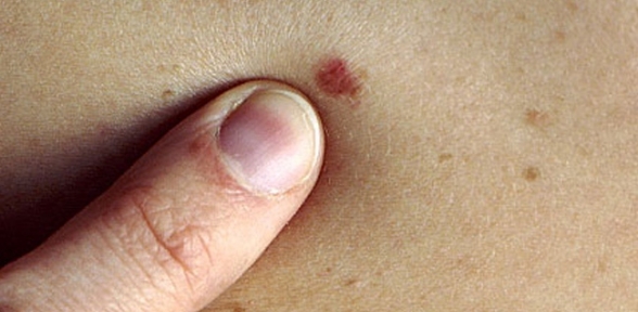 Deri kanserine ücretsiz tarama