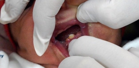 Esma Bebek Dişleriyle Doğdu 