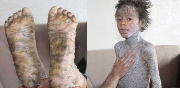 HASTALIĞI YÜZÜNDEN DIŞARIYA BİLE ÇIKAMIYOR