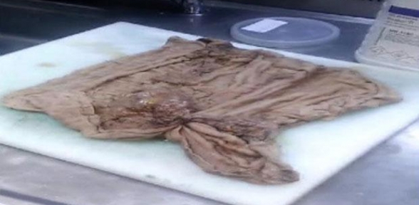 Hastanede skandal Ameliyat olan kadının karnından havlu büyüklüğünde bez çıktı