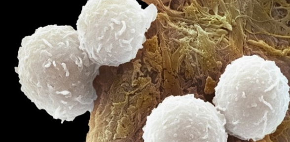 Kanser tedavisinde yeni bir kapı İnsanın kendi hücreleri kanseri alt edebilir mi